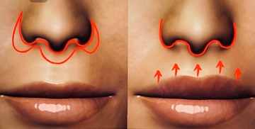 Qu’est-ce que le lift lip ou lifting de la lèvre supérieure ?