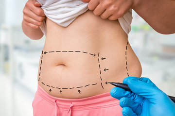 lipoaspiration : perdez la graisse en trop pour retrouver un belle silhouette